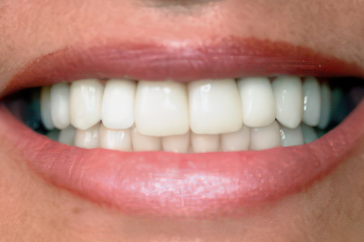 Dr. Berbari's patient after a smile makeover