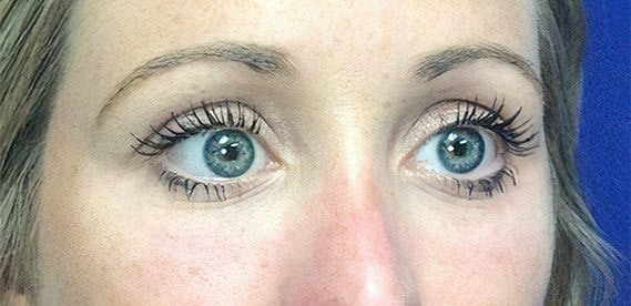 Restylane results around eyes