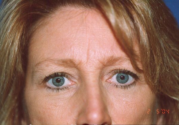Before brow lift