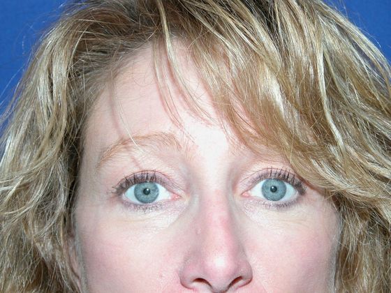 After brow lift