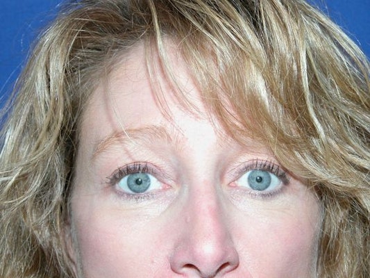 After brow lift