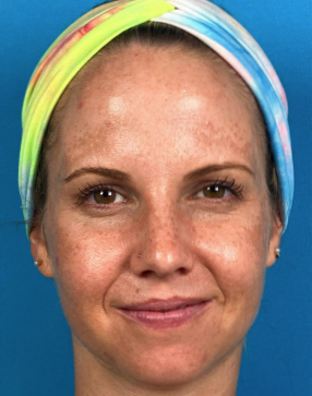 Woman with sun spots