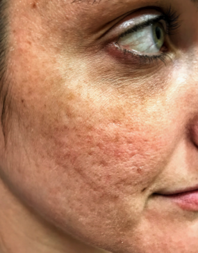 Woman with acne scars