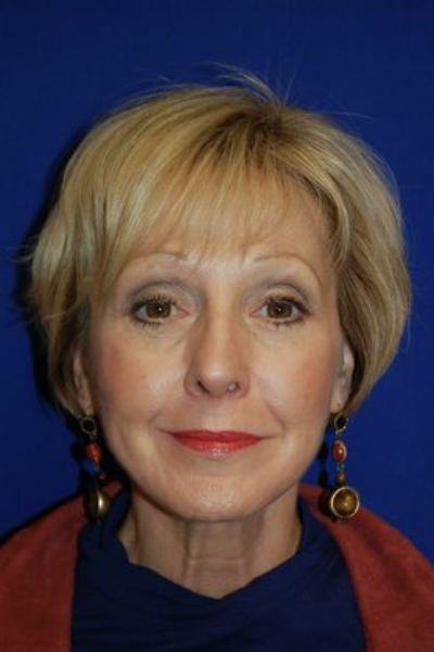 Mature woman after facelift