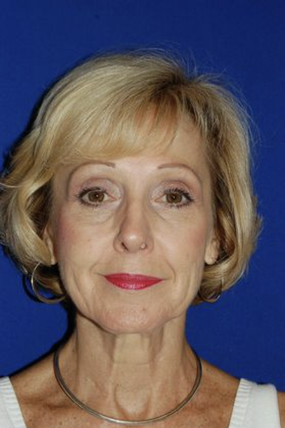 Mature woman before facelift