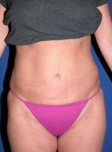 Woman after liposuction