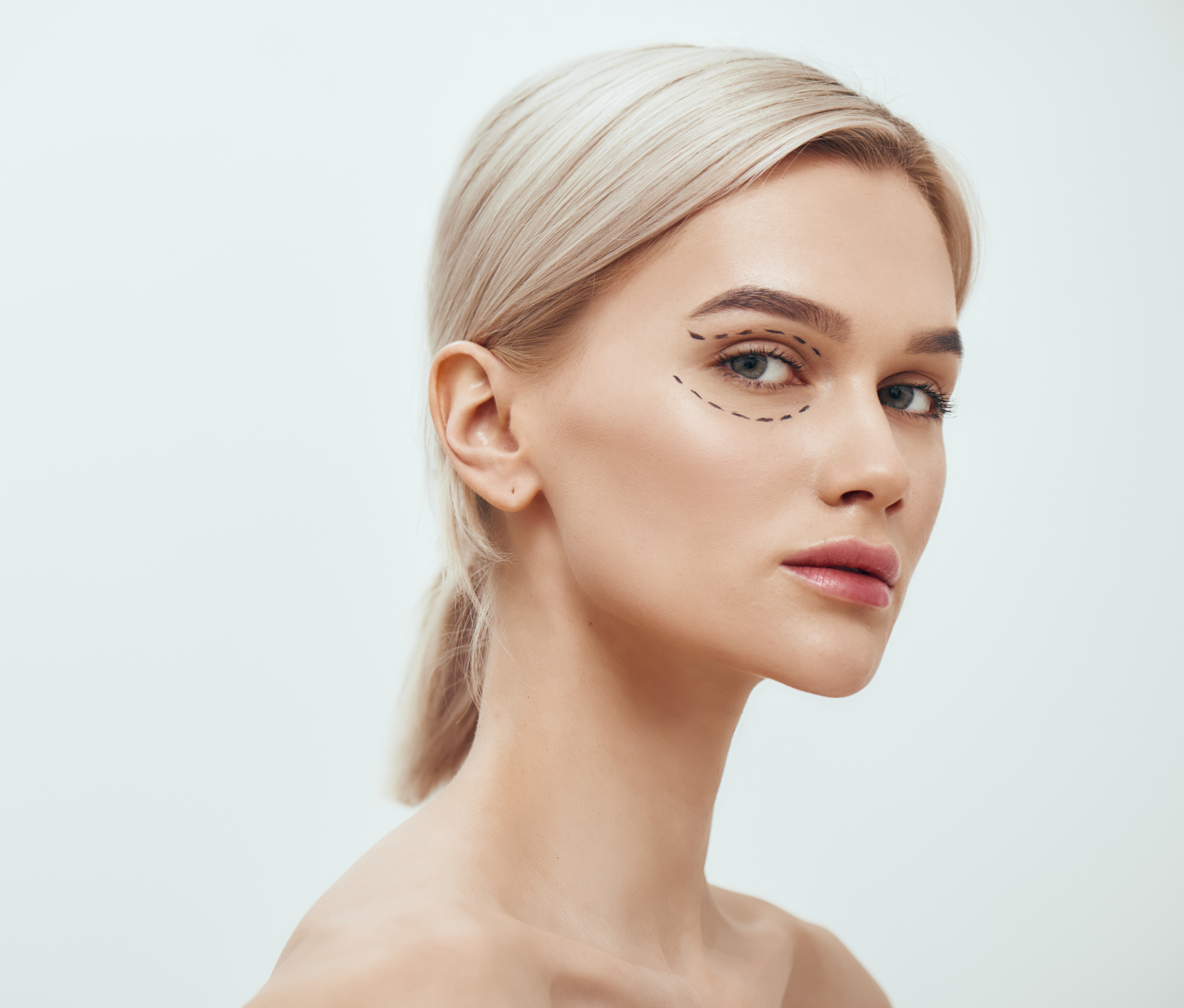 woman with marks for planning eyelid surgery