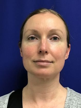 after blepharoplasty