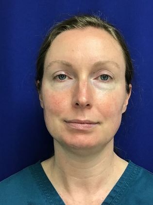 before blepharoplasty