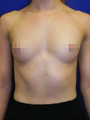 before breast implants