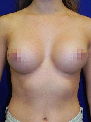 after breast implants
