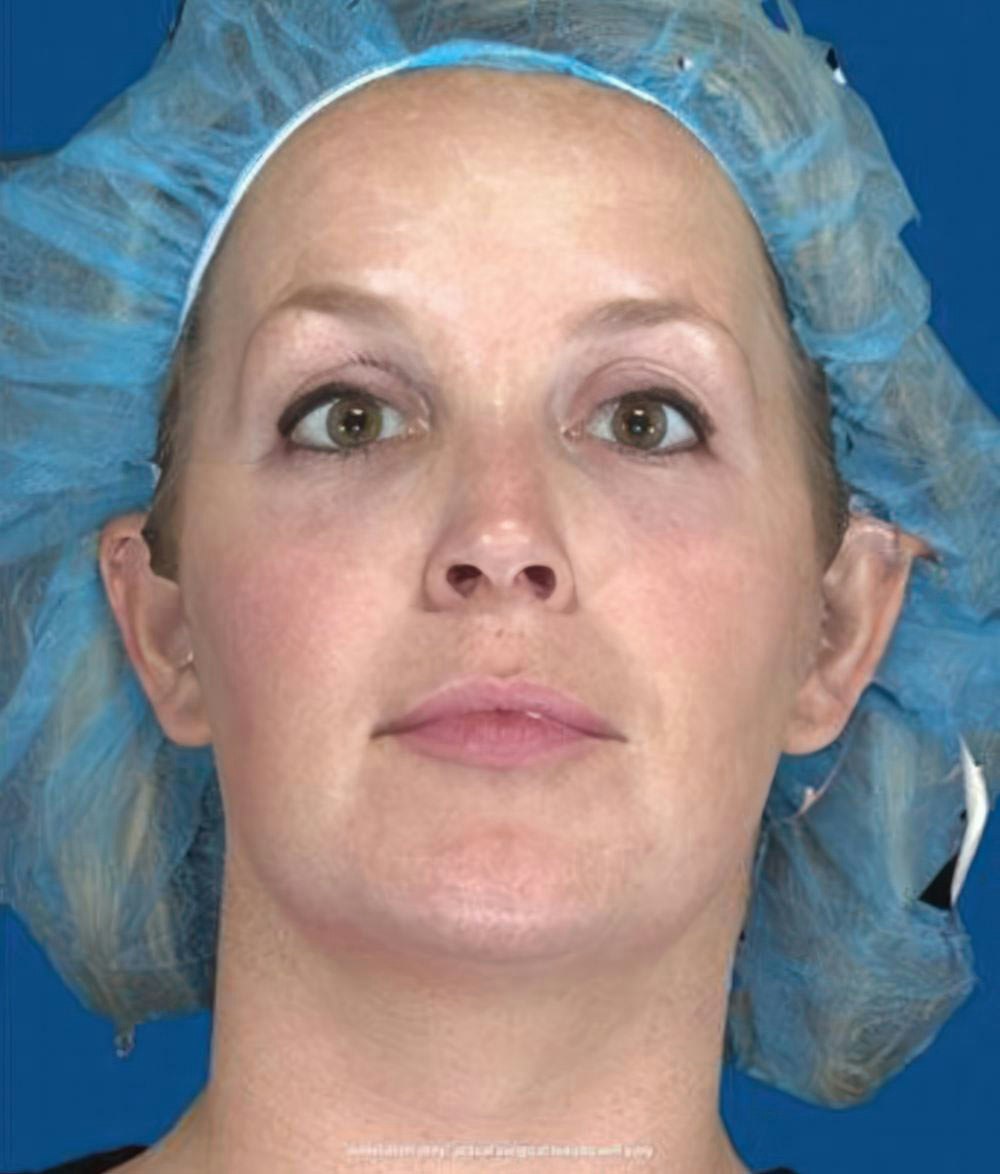 After a Chemical Peel