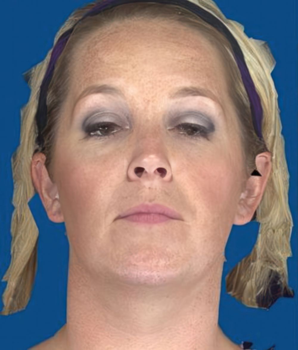 Before a Chemical Peel