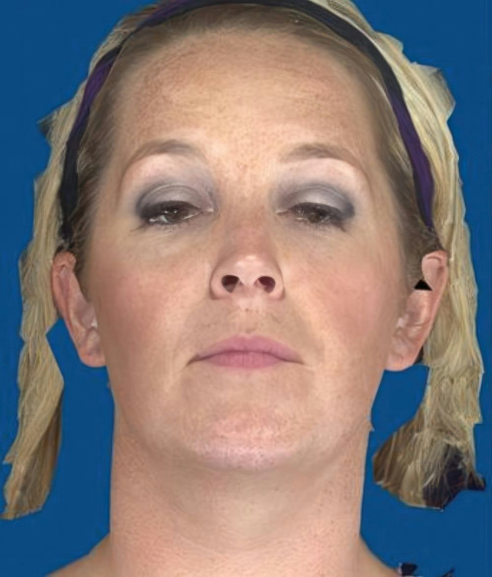 Before a Chemical Peel