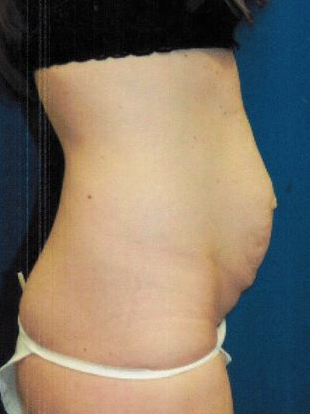 Dr. Sutton Graham's patient before tummy tuck