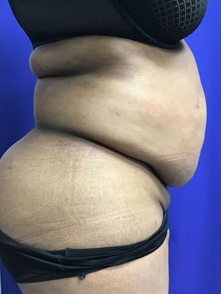 Dr. Sutton Graham's patient before an extended tummy tuck