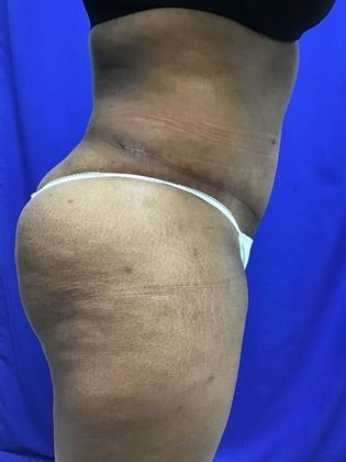Dr. Sutton Graham's patient after an extended tummy tuck