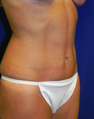 Dr. Sutton Graham's patient after a mommy makeover