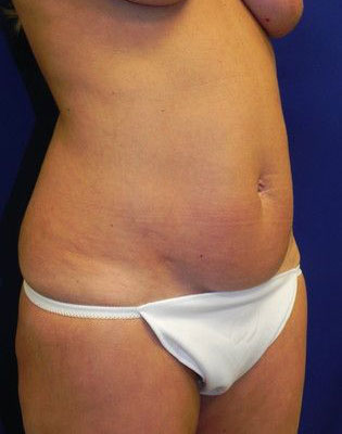 Dr. Sutton Graham's patient before a mommy makeover