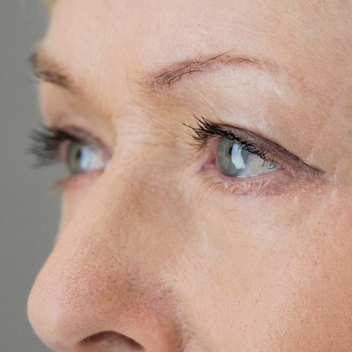 Woman's eyes after eyelid surgery