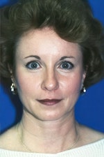 after blepharoplasty image