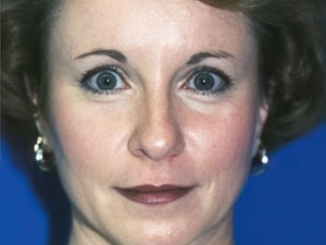 after blepharoplasty image