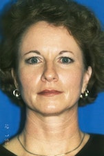 before blepharoplasty image