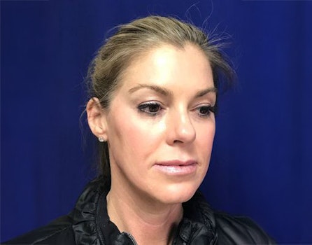 facial fat transfer result