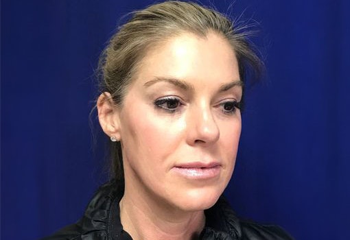facial fat transfer result