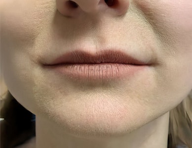 JUVEDERM results around mouth