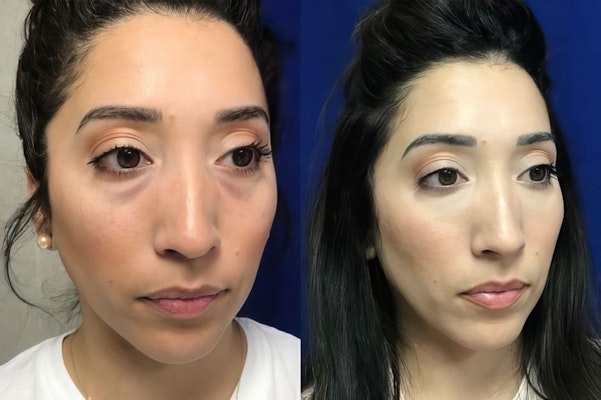 before and after restylane