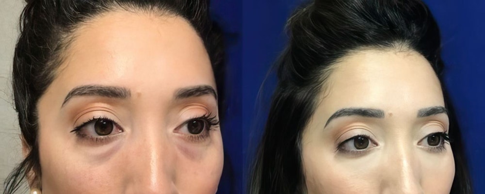 before and after restylane