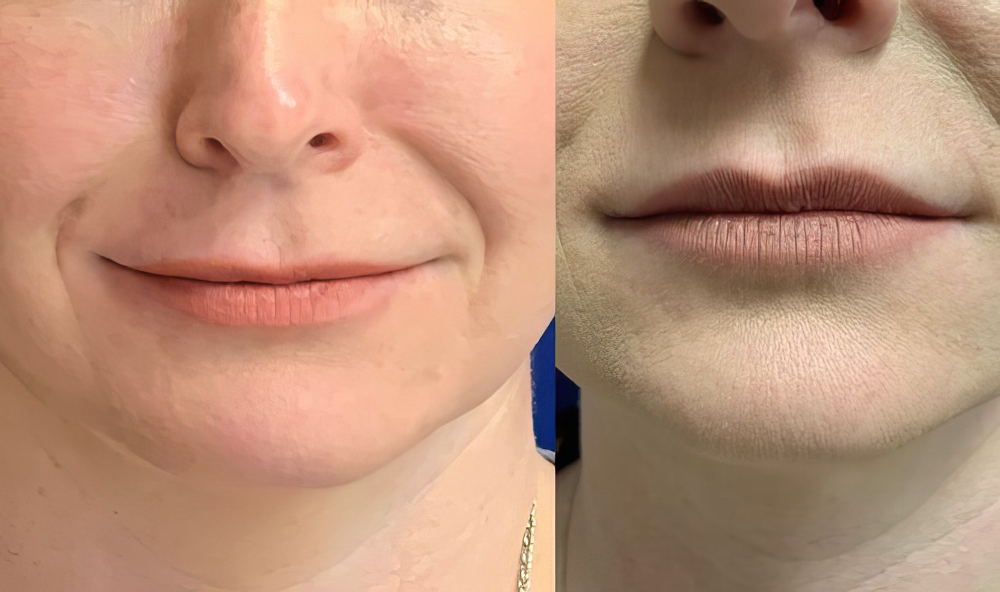 before and after juvederm
