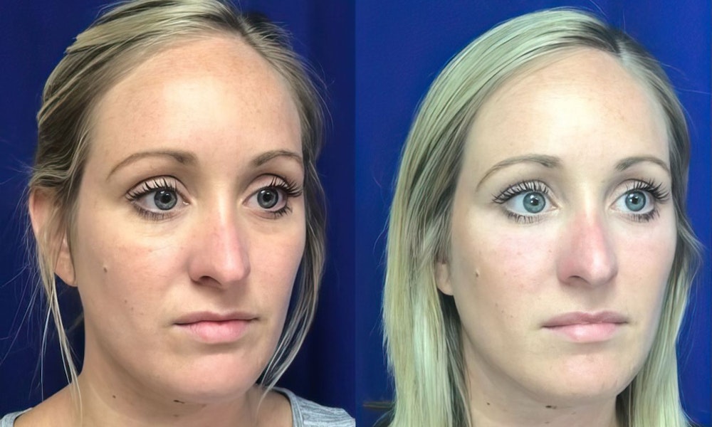 injectables B+A