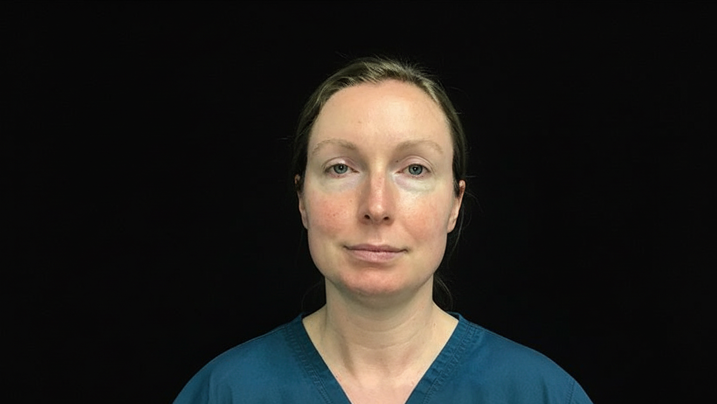 before blepharoplasty