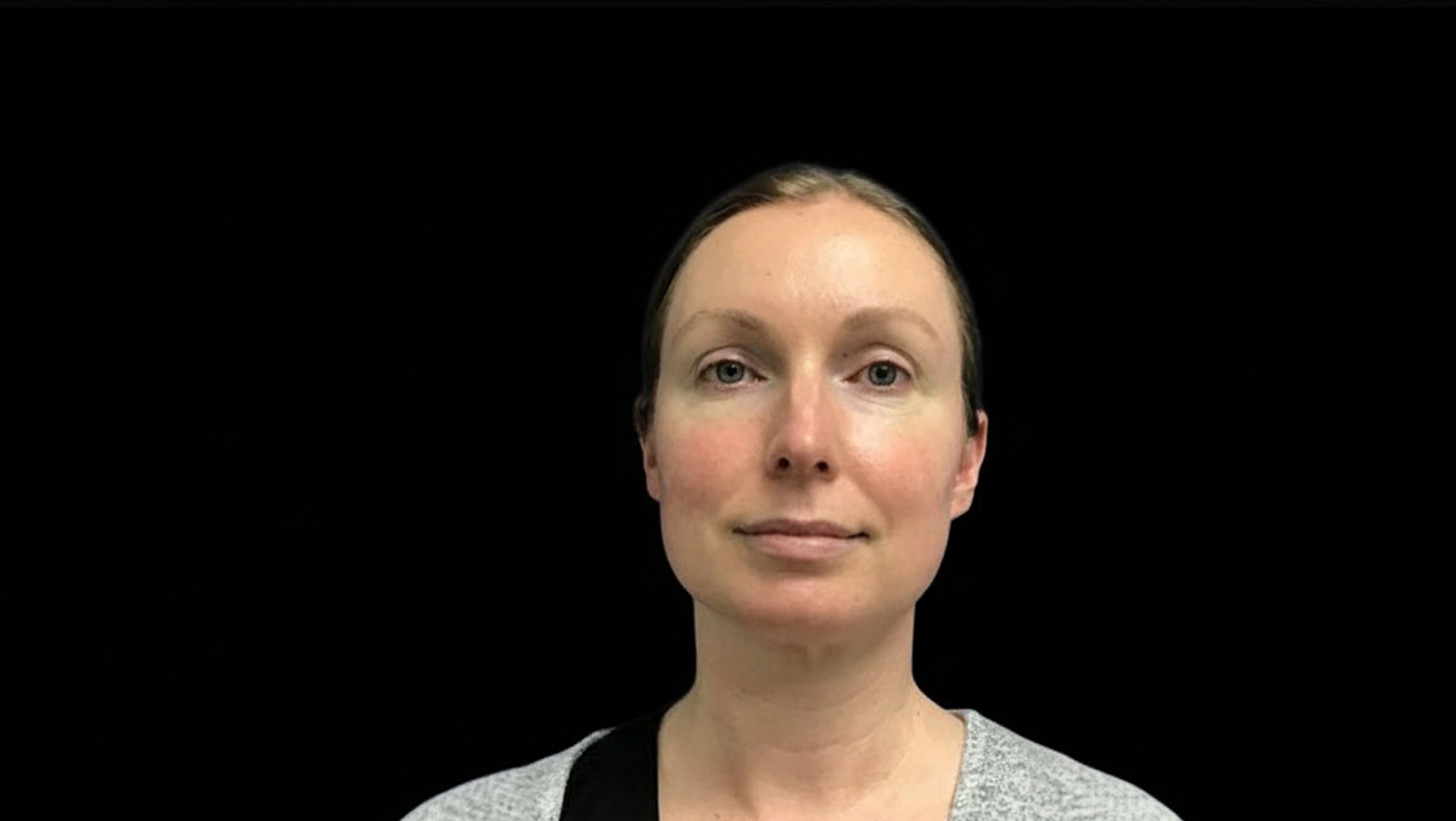 after blepharoplasty