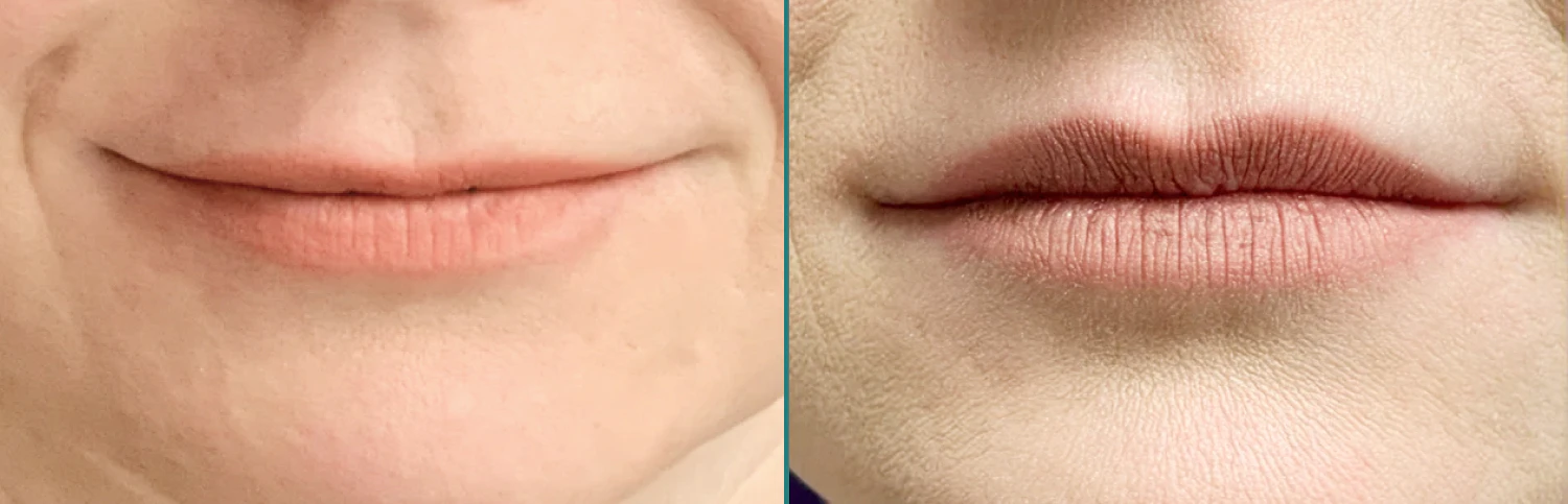 Real Patient Before and After Juvederm