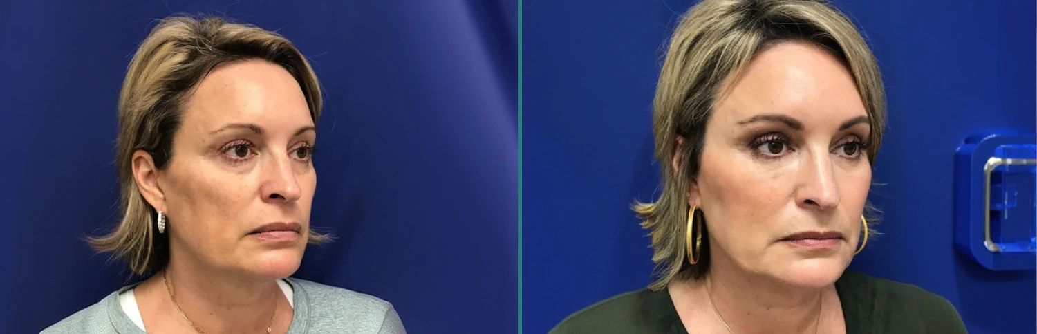 Real Patient Before and After Restylane