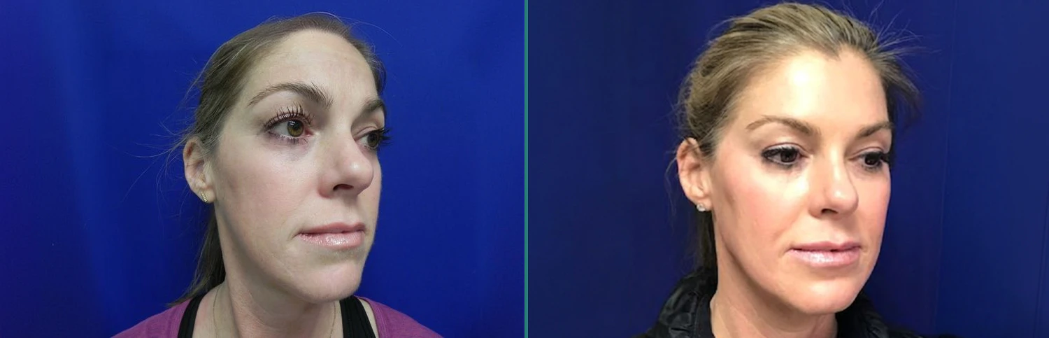 Real Patient Before and After Cheekbone Enhancement