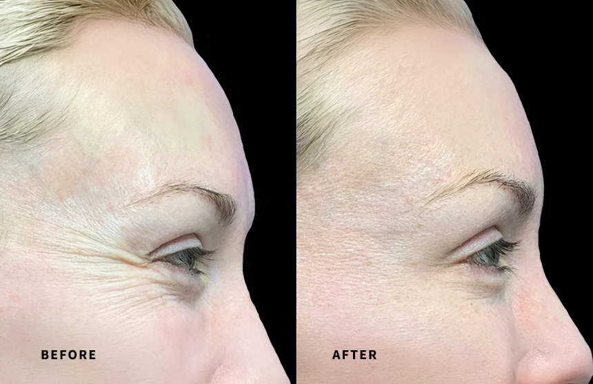 Real patient before & after botox treatment at Aesthetic Center Greenville