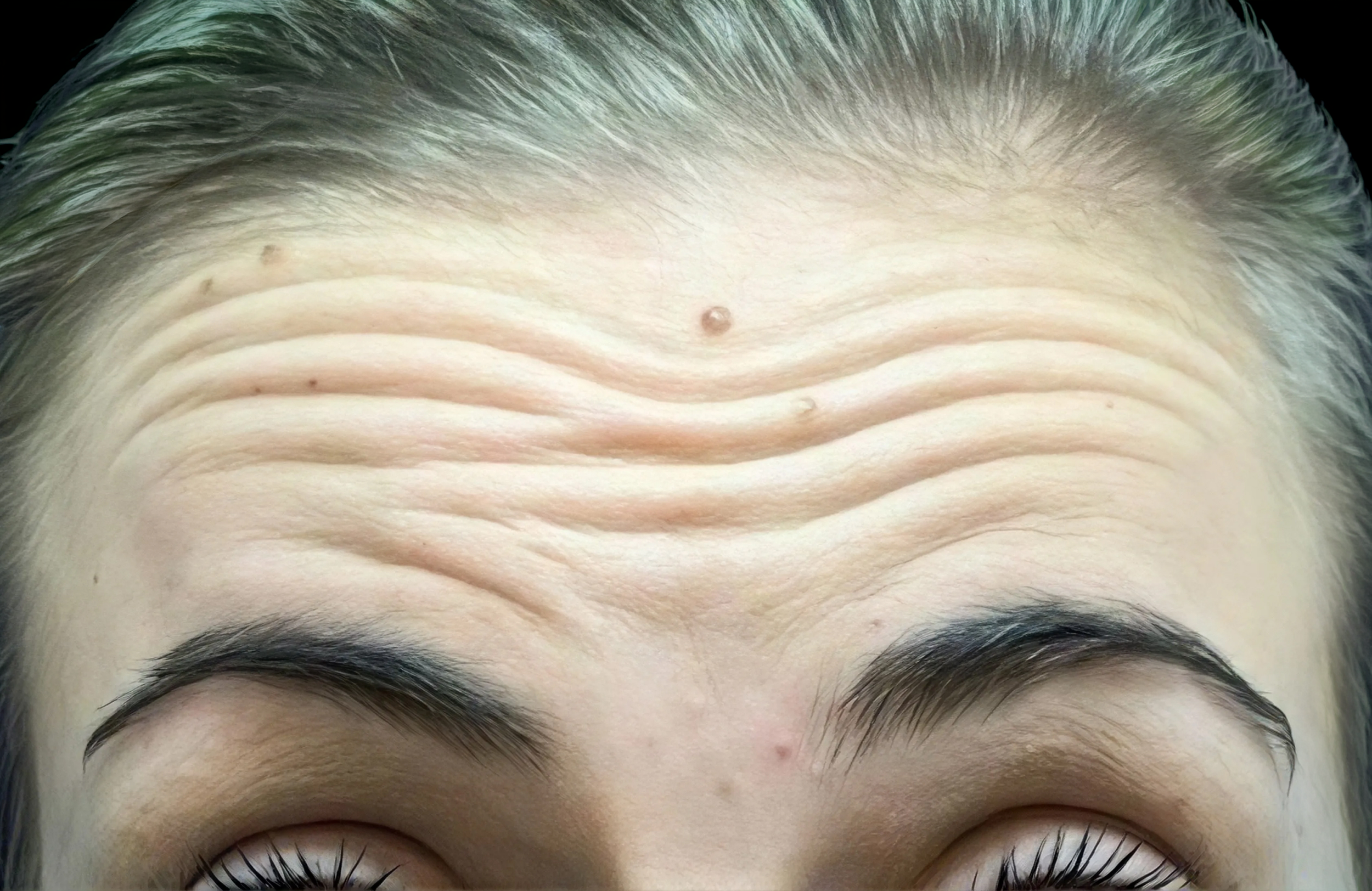 before injectables