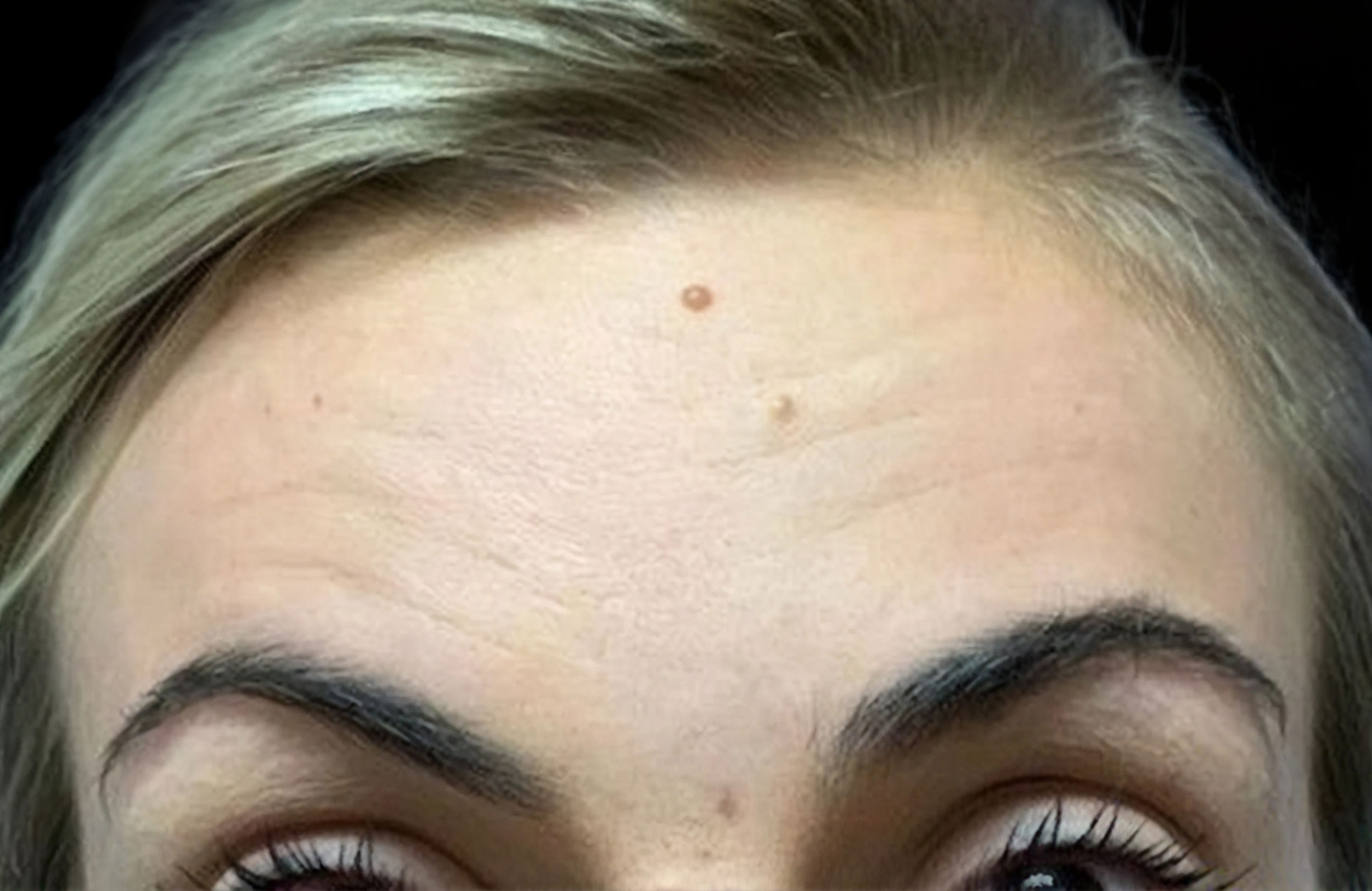 after injectables
