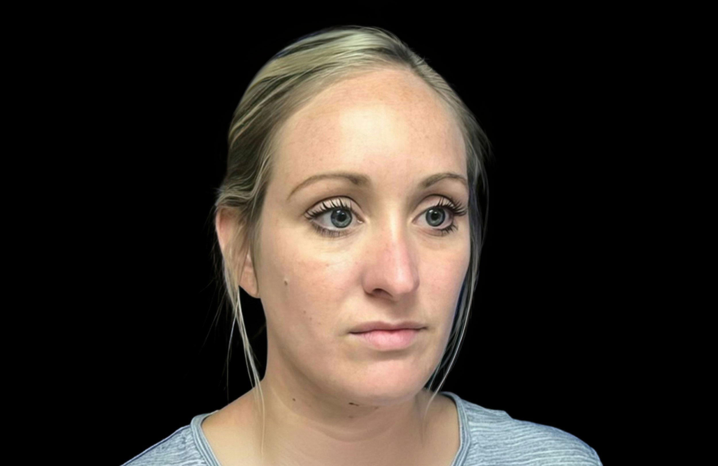 Before Restylane