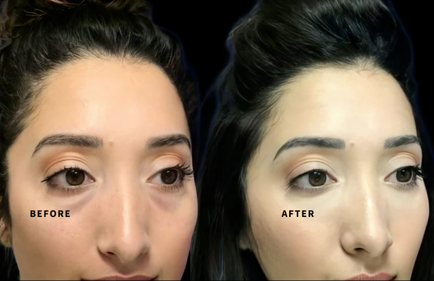 Real patient before & after Restylane® treatment at Aesthetic Center Greenville