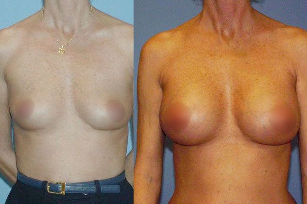 before and after breast augmentation