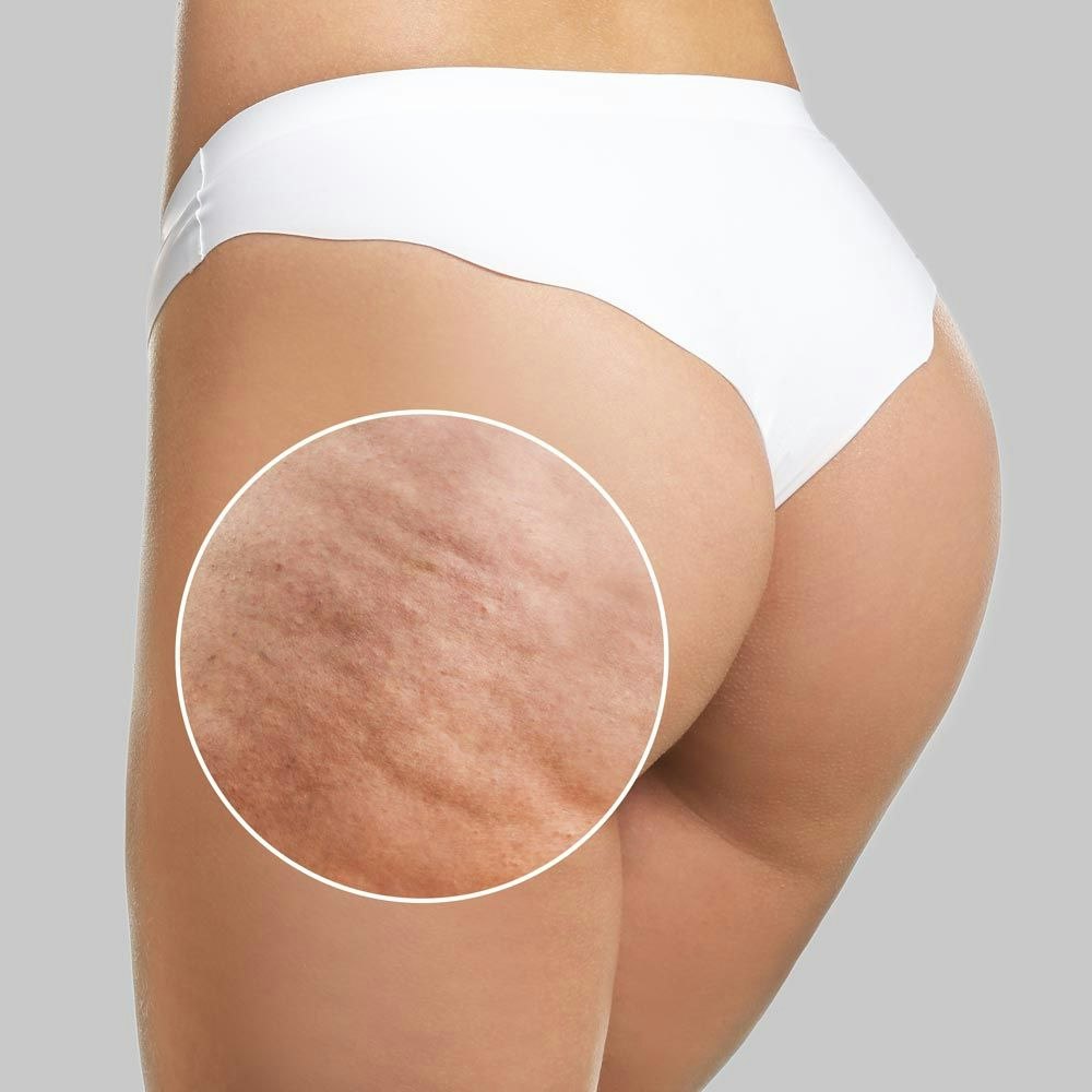 Closeup of cellulite on a woman's butt