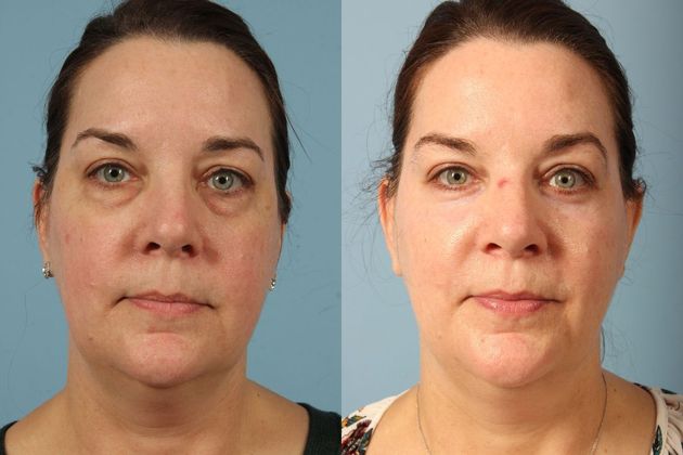 Before and after blepharoplasty procedure