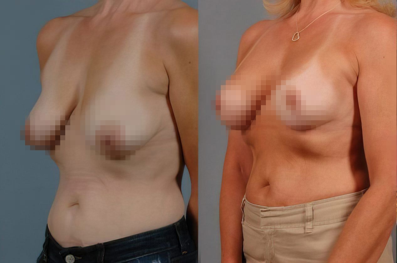 Collage of a woman with saggy breasts on the left and the same woman with perkier breasts on the right