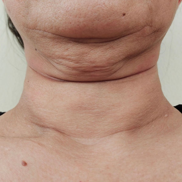 picture of neck