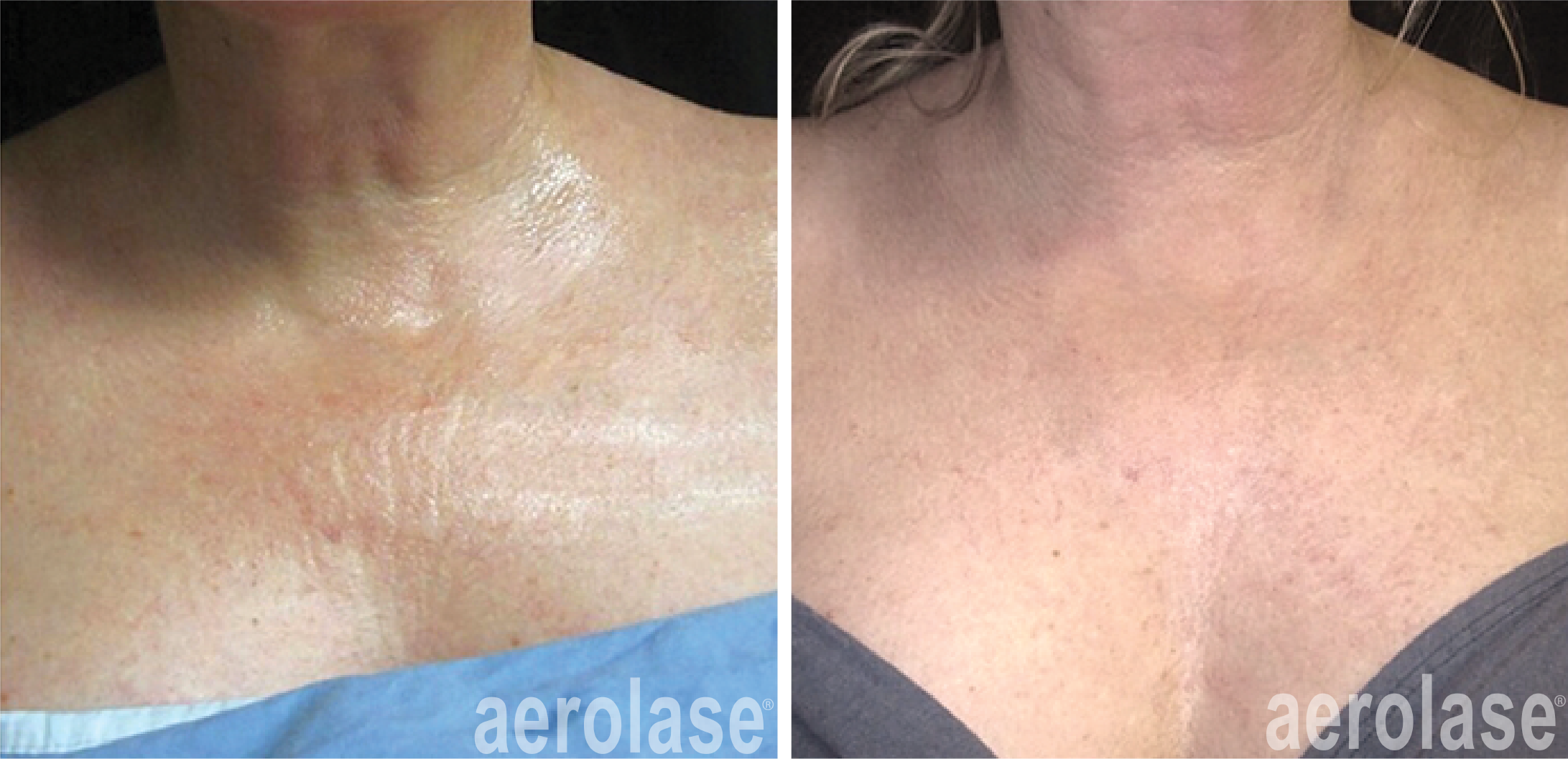 Jason before and after Neoskin Skin Rejuvenation